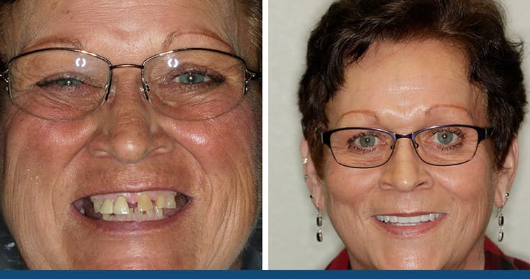 How Much Do Dentures Cost?