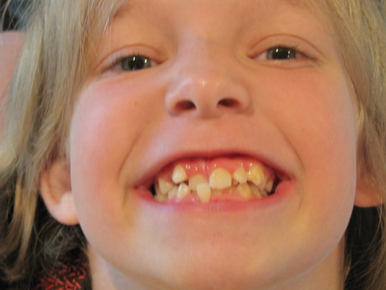 How Much do Braces Cost for Kids and Adults?