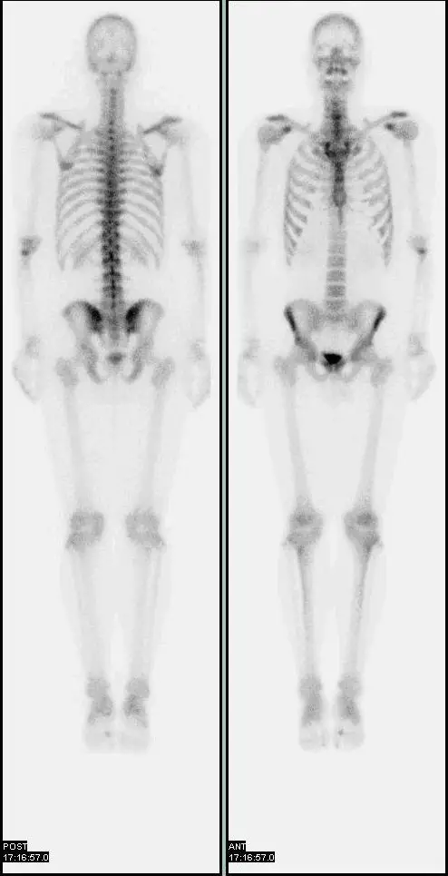 How Much Does a Bone Scan Cost?