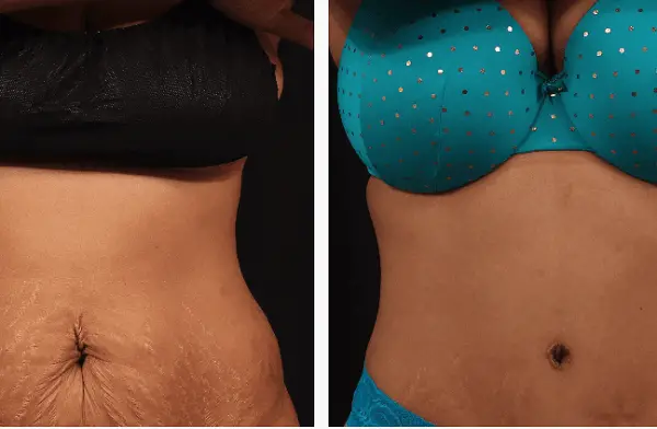 How much does a tummy tuck cost?