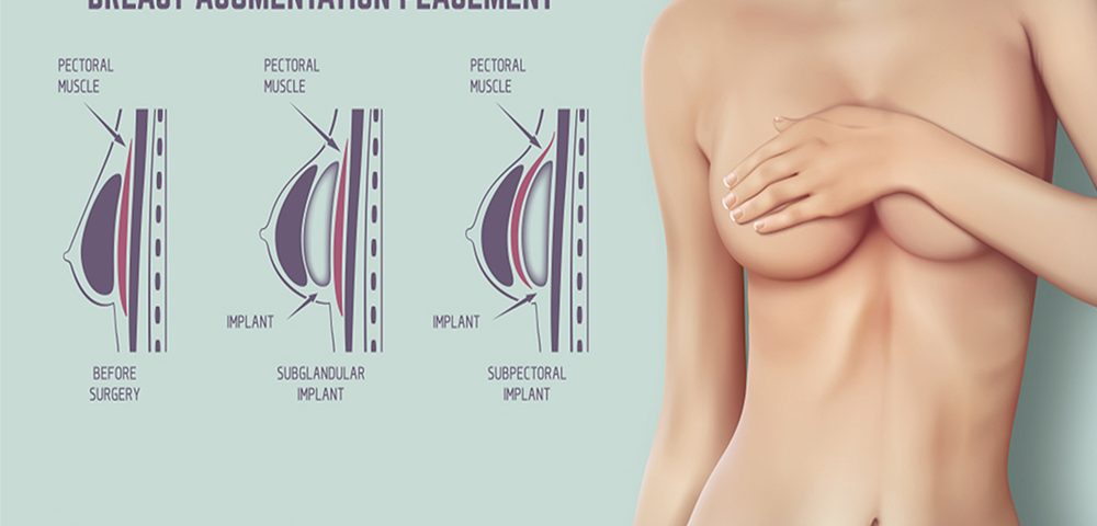 How Much Do Breast Implants Cost?