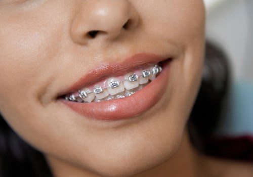 How Much Do Braces Cost?