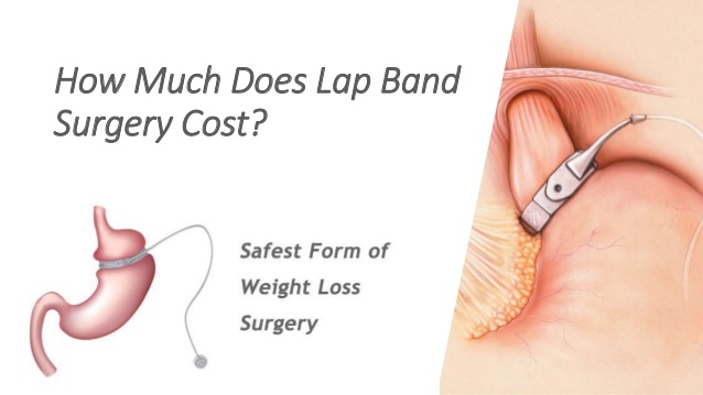 What is the Cost of Lap Band Surgery?