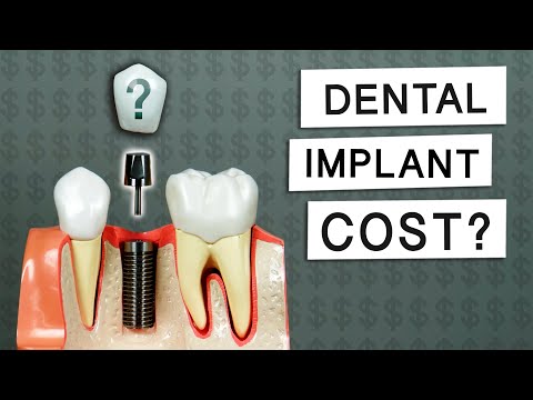 How Much Do Dental Implants Cost?