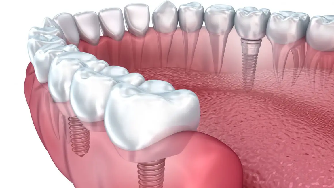 How Much Do Dental Implants Cost: Are Prices Reasonable For Average Person?