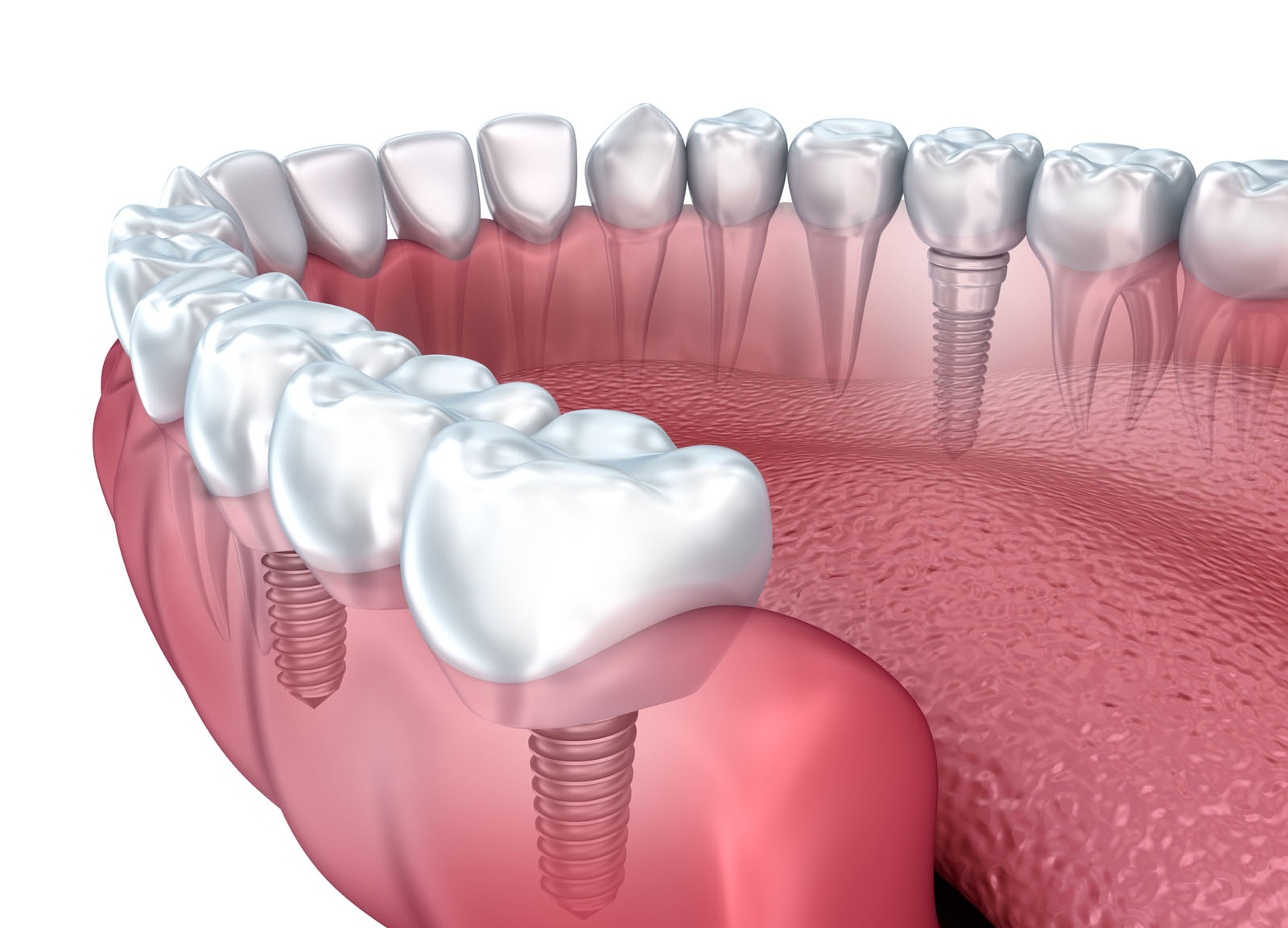 How Much Do Dental Implants Cost: Are Prices Reasonable For Average Person?