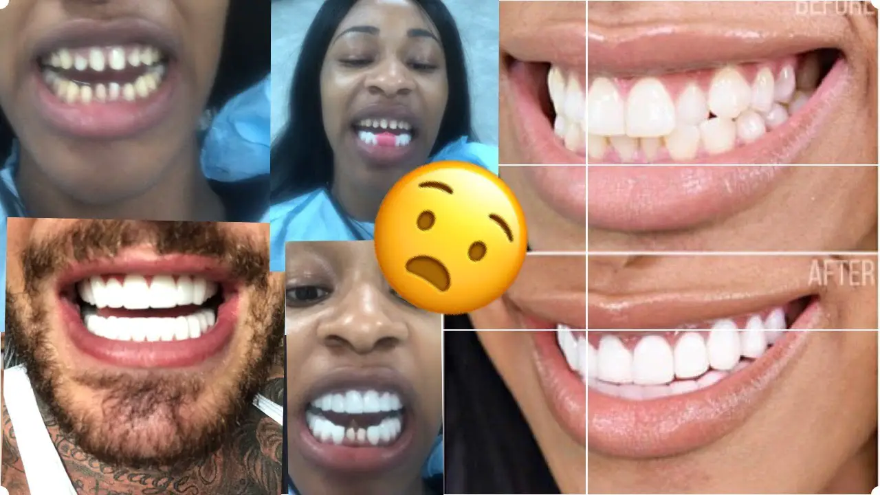 How Much Do Veneers Cost?