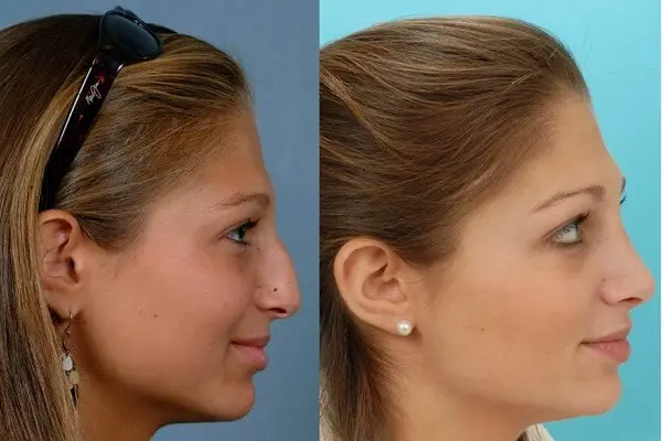 How Much Does A Nose Job Cost?